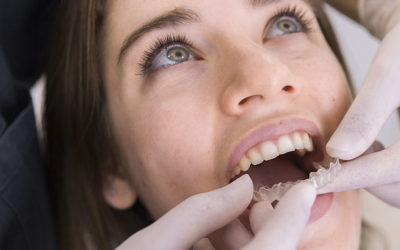 INVISALIGN: LA TÉCNICA MÁS CÓMODA PARA MEJORAR TU SONRISA