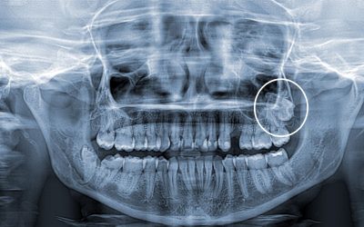 ¿TERCER MOLAR? DESCUBRE QUÉ ES Y COMO TRATARLO.